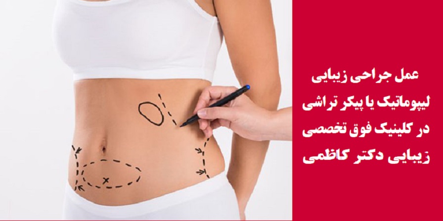 عمل جراحی زیبایی لیپوماتیک یا پیکر تراشی در کلینیک فوق تخصصی زیبایی دکتر کاظمی