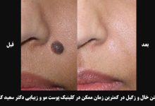 تصویر از برداشتن خال و زگیل در کمترین زمان ممکن در کلینیک پوست مو و زیبایی دکتر سعید کاظمی