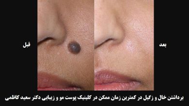 تصویر از برداشتن خال و زگیل در کمترین زمان ممکن در کلینیک پوست مو و زیبایی دکتر سعید کاظمی